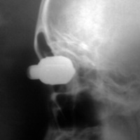Figura 3. Radiografía de cráneo de perfil donde se visualiza cuerpo extraño metálico que ocupa toda la cavidad orbitaria.