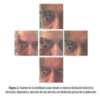 Figura 2. Examen de la motilidad ocular donde se observa limitación total de la elevación, depresión y aducción del ojo derecho con limitación parcial de la abducción.