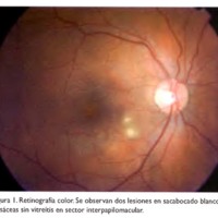 Toxocariasis ocular de presentación atípica en adolescente de 18 años