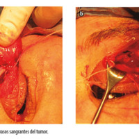 Figura 4 a y b. Escisión y ligación de vasos sangrantes del tumor.