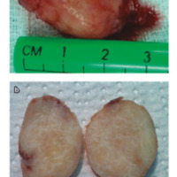 Figura 12. Macroscopía. Lesión bien delimitada por pseudocápsula. Al corte macroscópico se observa lesión blanquecina homogénea.