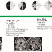 Figura 3. Línea temporal donde se muestra evolución de los campos visuales, agudeza visual y RMN durante 18 meses; desde el diagnóstico, posterior a cirugía y tratamiento con radioterapia, y último control al año del tratamiento.