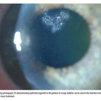 Figure 2. Slit-lamp photograph, OS demonstrating epithelial ingrowth in the pattern of a map, bubbles can be seen in the interface immediately after 1st<br />
session of Nd:YAG laser treatment.