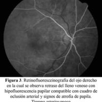 Figura 3. Retinofluoresceinografía del ojo derecho en la cual se observa retraso del lleno venoso con hipofluorescencia papilar compatible con cuadro de oclusión arterial y signos de atrofia de papila. Tiempo arteriovenoso.