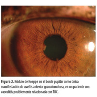 Figura 2. Nódulo de Koeppe en el borde pupilar como única manifestación de uveítis anterior granulomatosa, en un paciente con vasculitis posiblemente relacionada con TBC.