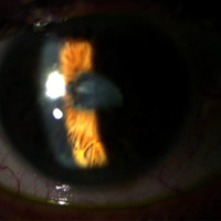 Figura 2. Se aprecian las sinequias posteriores pupilares en 360º. 