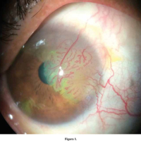 Neoplasia intraepitelial corneal tratada con interferón alfa-2B: reporte de caso