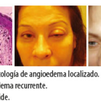 Figura 29. Histopatología de angioedema localizado.<br />
Figura 30. Angioedema recurrente.<br />
Figura 31. LE discoide.