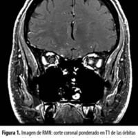 Figura 1. Imagen de RMN: corte coronal ponderado en T1 de las órbitas con saturación de grasa que muestra el agrandamiento del nervio óptico intraorbitario izquierdo en un paciente con neuritis óptica.
