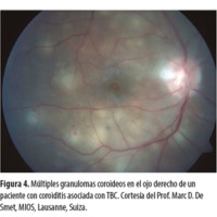 Figura 4. Múltiples granulomas coroideos en el ojo derecho de un paciente con coroiditis asociada con TBC. Cortesía del Prof. Marc D. De Smet, MIOS, Lausanne, Suiza.