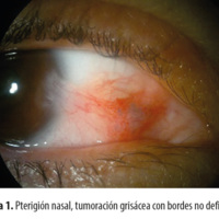 Figura 1. Pterigión nasal, tumoración grisácea con bordes no definidos.