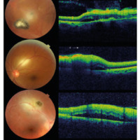 Figura 2. Casos 37, 30 y 1. Focos de retinitis con desprendimiento de neuroepitelio. Hialoides parcial o totalmente adherida, engrosamiento hiperreflectivo de la retina interna e imagen hiporreflectiva subretinal.