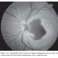 Obstrucción de la arteria central de la retina postembolización de un presunto angiofibroma nasofaríngeo 