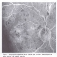Rubeosis iridis pos oclusión de vena central de retina tratada con bevacizumab intravítreo y panfotocoagulación: informe de un caso y revisión bibliográfica