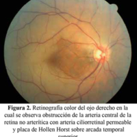 Figura 2. Retinografía color del ojo derecho en la cual se observa obstrucción de la arteria central de la retina no arterítica con arteria ciliorretinal permeable y placa de Hollen Horst sobre arcada temporal superior.