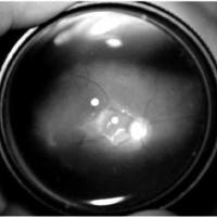 Hemorragia retinal en un lactante como presentación de presunta toxocariasis ocular