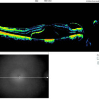 Figura 5. OCT OD macular. Se observan imágenes de hiporrefringencia subretinales e intrarretinales a nivel de las capas internas de la retina con un aumento del espesor macular (EM) 681 μm que se corresponde con edema macular.