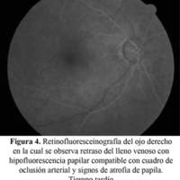 Figura 4. Retinofluoresceinografía del ojo derecho en la cual se observa retraso del lleno venoso con hipofluorescencia papilar compatible con cuadro de oclusión arterial y signos de atrofia de papila. Tiempo tardío.