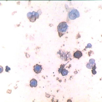 Figura 7. Vítreo. Citopatología en linfoma intraocular. Presencia de linfocitos atípicos positivos para CD 20. 