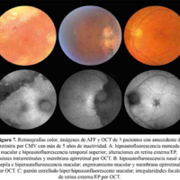 Figura 7. Retinografías color, imágenes de AFF y OCT de 3 pacientes con antecedente de retinitis por CMV con más de 5 años de inactividad. A: hipoautofluorescencia moteada macular e hipoautofluorescencia temporal superior; alteraciones en retina externa/ EP, quistes intrarretinales y membrana epirretinal por OCT. B: hipoautofluorescencia nasal a papila e hiperautofluorescencia macular; engrosamiento macular y membrana epirretinal por OCT. C: patrón estrellado hiper/hipoautofluorescente macular; irregularidades focales de retina externa/EP por OCT.