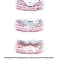 Figura 3. a) Un desprendimiento senil del vítreo posterior aparece en la región perifoveal al tiempo que la hialoides posterior permanece adherida a la fóvea. Una MER inicia su crecimiento alrededor del DPV (estadio 1). b) El desprendimiento parcial del vítreo posterior ocasiona cierto grado de tracción vitreomacular con el consecuente desplazamiento anterior de las capas más internas de la retina. La retina se prolapsa por adelante el borde interno<br />
de la MER (estadio 2). c) Un DPV completo ocurre perdiendo la hialoides posterior su relación con la fóvea. Las fuerzas centrípetas contenidas en la MER<br />
producen una contracción generalizada que lleva al pinzamiento y prolapso macular anterior del tejido retinal (estadio 3).