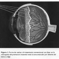 Innovación al tratamiento convencional con láser en la retinopatía del prematuro