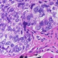 Figura 1. B) Grupos de células medianas-grandes con núcleo vesiculoso, nucleolos prominentes y actividad mitótica evidente (carcinoma sebáceo).