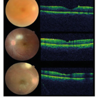 Figura 3. Casos 12, 19 y 29. Alteraciones maculares detectadas por SD-OCT en retinitis extrafoveal nasal, temporal superior y temporal superior. Depósitos hiperreflectivos esféricos sobre la superficie de la retina, ondulaciones del perfil interno, edema, aumento de la reflectividad interna y alteraciones en retina externa y EPR.