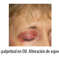 Figura 1. Eritema palpebral en OD. Alteración de aspecto de la piel en OI.