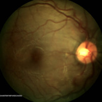 Figura 16. RG Color OD. Se observa una mejoría a nivel macular, no se visualiza edema parafoveal.