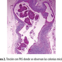 Figura 2. Tinción con PAS donde se observan las colonias micóticas.