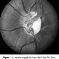 Figura 3. Asa vascular prepapilar (cortesía del Dr. José Díaz Rubio, Aguascalientes, México).