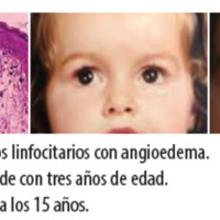 Figura 11. Infiltrados linfocitarios con angioedema. <br />
Figura 12. Paciente de con tres años de edad. <br />
Figura 13. Paciente a los 15 años.