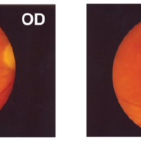 Figura 2. Paciente 4, reactivación de una pequeña lesión corrioretinal en el ojo izquierdo y vitreítis leve en el ojo contralateral con síndrome de Fuchs sin lesiones<br />
corrioretinales activas evidentes.