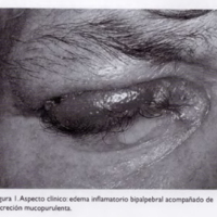 Compromiso oftalmológico en paracoccidioidomicosis