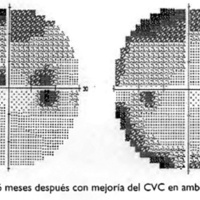 Fig. 4. Caso I. 6 meses después con mejoría del CVC en ambos ojos.