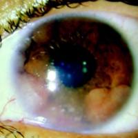 Comportamiento, curso y manejo de la enfermedad linfoproliferativa postrasplante con compromiso ocular 