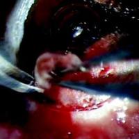 Rechazo estromal en queratoplastia lamelar: informe de un caso