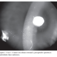 Rechazo corneal post queratoplastia laminar anterior predescemética en pacientes con ectasias corneales no inflamatorias