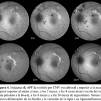 Figura 4. Imágenes de AFF de retinitis por CMV yuxtafoveal y superior a la arcada temporal superior al inicio, al mes, a los 2 meses, a los 4 meses (reactivación del sector más próximo a la fóvea), a los 8 meses y a los 20 meses de seguimiento. Nótese la progresiva delimitación de los bordes y la variación de la hiper a su hipoautofluorescencia.