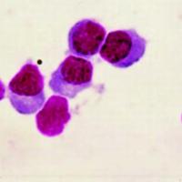 Figura 2. Células linfoides con diferenciación plasmocitoide en el humor acuoso (Diff-Quick, X400).