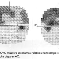 Fig. 3. Caso I. CVC muestra escotomas relativos hemicampo superior y aumento mancha ciega en AO.