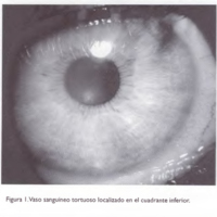 Malformación arteriovenosa de iris