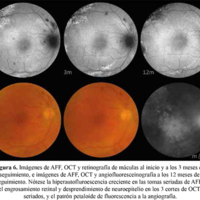 Figura 6. Imágenes de AFF, OCT y retinografía de máculas al inicio y a los 3 meses de seguimiento, e imágenes de AFF, OCT y angiofluoresceinografía a los 12 meses de seguimiento. Nótese la hiperautofluorescencia creciente en las tomas seriadas de AFF, el engrosamiento retinal y desprendimiento de neuroepitelio en los 3 cortes de OCT seriados, y el patrón petaloide de fluorescencia a la angiografía.