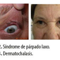 Figura 32. Síndrome de párpado laxo.<br />
Figura 33. Dermatochalasis.