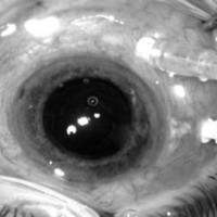 Vitrectomía 25G en Glaucoma Maligno.