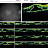 Figura  6. OCT OD macular. Se observan imágenes de hiporrefringencia subretinales e intrarretinales a nivel de las capas internas de la retina con un aumento del espesor macular (EM) 681 μm que se corresponde con edema macular.