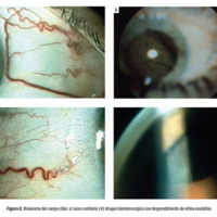 Figura 8. Melanoma del cuerpo ciliar: a) vasos centinela y b) imagen biomicroscópica con desprendimiento de retina exudativo.