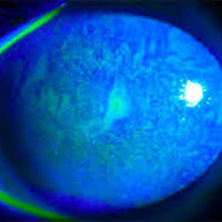 Figura 4. Pseudomembrana tarsal producto de la severa inflamación ocular.
