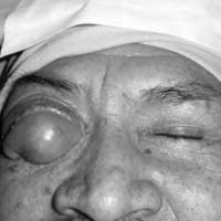 Figura 1. Marcada quemosis que no permite visualizar el globo ocular derecho.